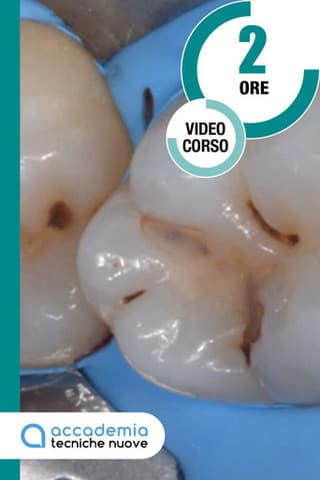 Immagine copertina La gestione diagnostica-clinica dei solchi e delle fossette occlusali pigmentate - 2023