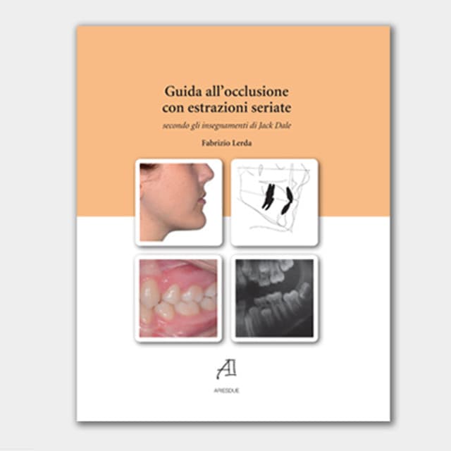 Guida all’occlusione con estrazioni seriate secondo gli insegnamenti di Jack Dale